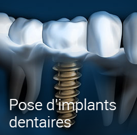 Dentiste-Bordeaux-Implant-dentaire-Esthétique-Soins-conventionnelssdfghh