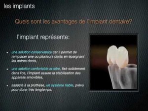 Qu'est-ce qu'un implant dentaire ?
